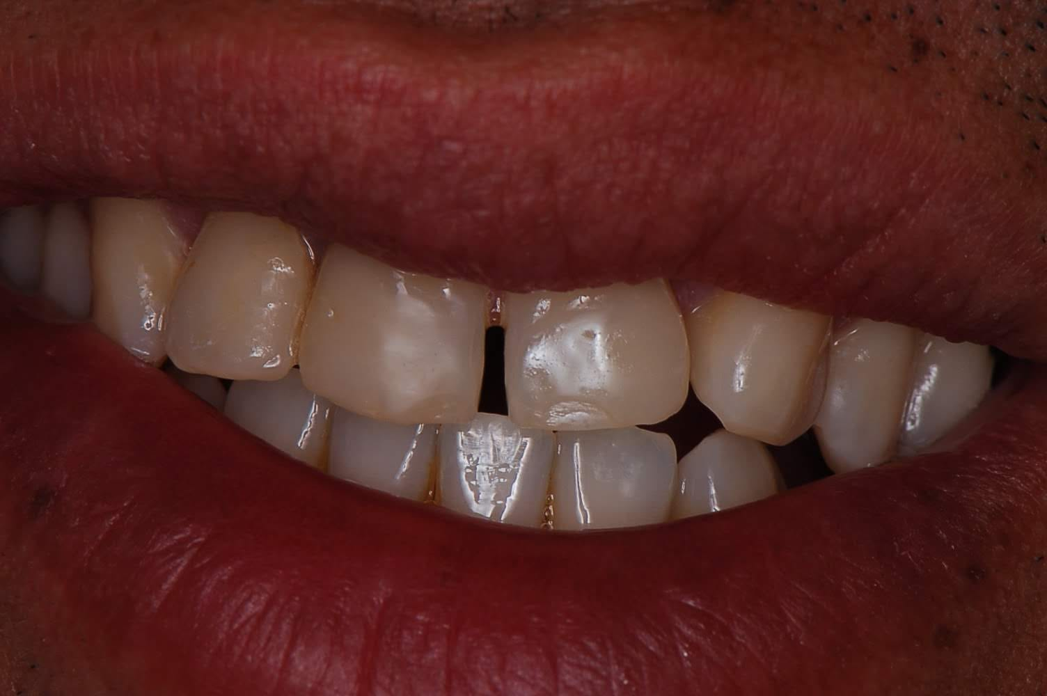 Antes — Prótese Dentária em Curitiba